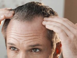 Minoxidil-una-de-las-mejores-opciones-para-la-caida-de-pelo