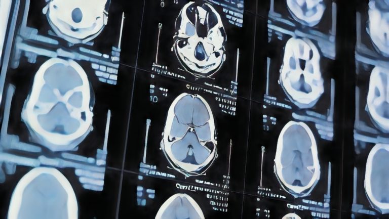 La-forma-del-cerebro-podria-revelar-los-primeros-signos-de-esta-grave-enfermedad