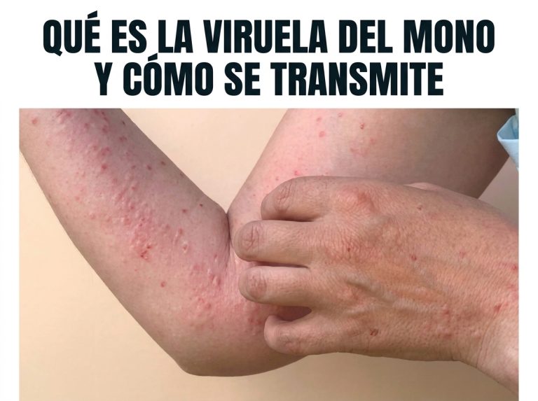 confirmacion-de-casos-de-mpox-en-san-cristobal-3d7ebfad-focus-0-0-375-240.jpg_202608011801